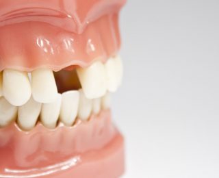 La perte des dents est-elle inévitable avec l’âge ?